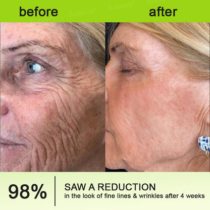 ✅Rolimey® Botox And Vita A Retinol Shot Wrinkle-Lift Tightening cream